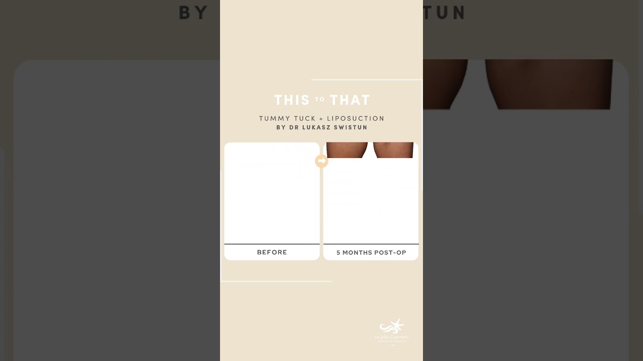 Watch This Patient's Transformation After a Tummy Tuck & Liposuction | La Jolla Cosmetic﻿﻿