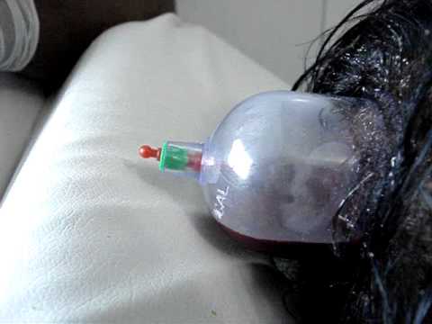 حجامة وسط الرأس بالعسل مع الأستاذ محمد بلهنتوت اخصائي الطب التكميلي بالمغرب Youtube