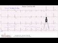 ECG Interpretation Tutorial - ChalkTalk 08 - Basic Level