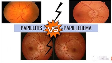 PAPILLITIS v/s PAPILLEDEMA