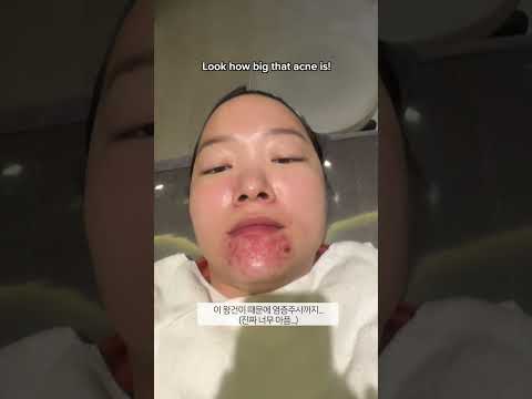 How my acne is treated at the dermatologist!