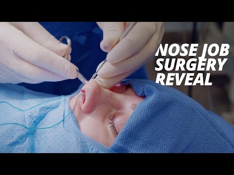 Video: Ang Isang Babaeng Sumailalim Sa Rhinoplasty Sa Turkey Ay Nahulog Sa Pagkawala Ng Malay Sa Loob Ng 3 Buwan