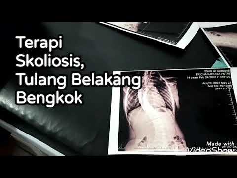 Tempat terapi pengobatan penyakit tulang belakang bengkok, Skoliosis, Kifosis, Lordosis, sembuh di Jember Jawa Timur. MDi- Pusat Rujukan Terapi Indonesia
