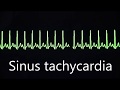 Cardiovascular System 8, Normal and abnormal heart rhythms