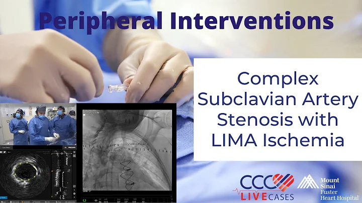 Complex Subclavian Artery Stenosis with LIMA Ischemia