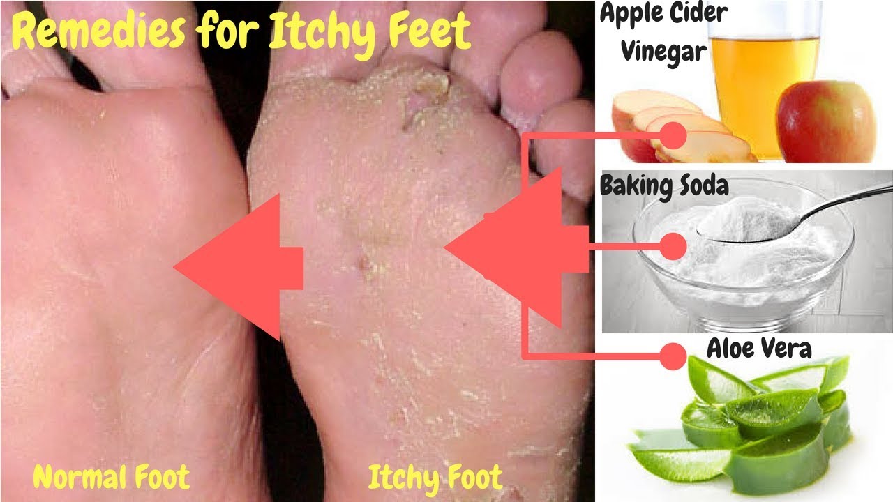 Follow These 5 Major Home Remedies For Itchy Feet Youtube