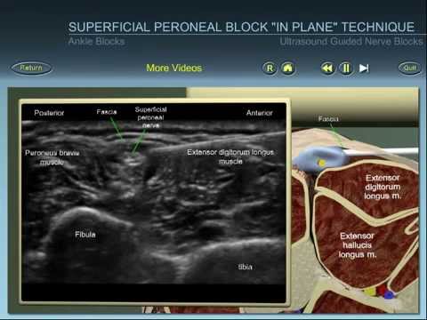 Ankle block: superficial peroneal nerve ultrasound guided block "in