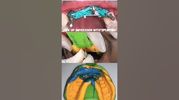 Transforming Lives: Watch the Amazing Dental Implant Placement and Prosthesis Process! 🦷✨"