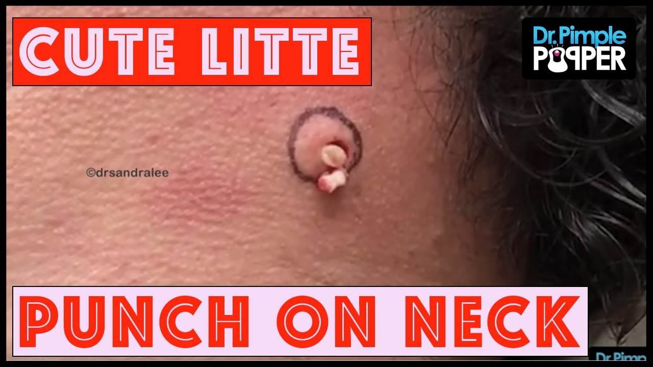 Dr Pimple Popper Pops Donut Filling Steatocystoma On Instagram