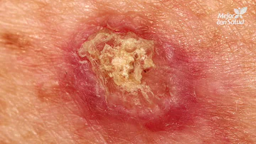 ¿Qué causa las pequeñas protuberancias negras en la piel?