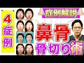 鼻の整形【鼻骨骨切り術】4症例紹介