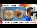Step by step layering composite class ii lower molar endo  resto  general dentist griya rr