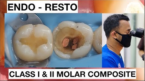 Step by Step Layering Composite Class II Lower Molar Endo - Resto | General Dentist Griya RR