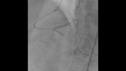 Coronary Intervention Stentin PCI PTCA PCI, V-Stent