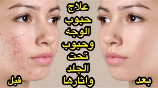 علاج حبوب الوجه + حبوب تحت الجلد + اثار الحبوب /باسهل طرق /مجرب ومظمون 100%