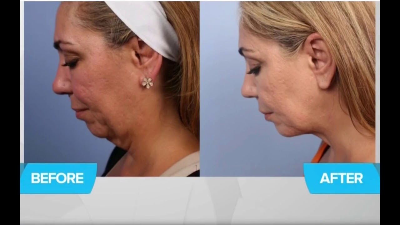 Mini FaceLift With Dr. Mulholland l SpaMedica