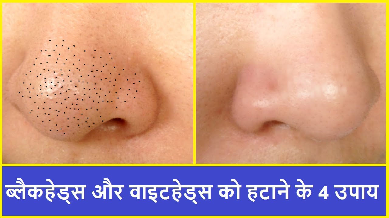 Blackheads And Whiteheads क हट न क 4 उप य Remove