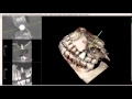 Upper Molar/Internal Sinus Lift 3-D Scan Dental Implant Planning - Narrated by Ramsey Amin DDS