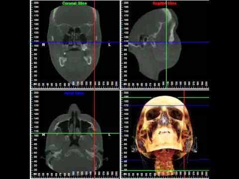 Volume Slicing In 3 Dimensions 3d Cone Beam Ct Scan And