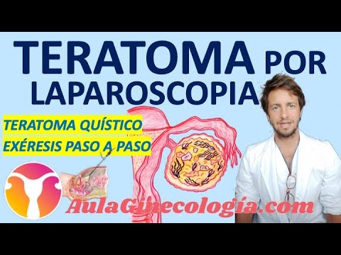 TERATOMA POR LAPAROSCOPIA: CIRUGÍA PASO A PASO... - Ginecología y Obstetricia -