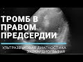 ТРОМБ В ПРАВОМ ПРЕДСЕРДИИ😵 ЭХОКАРДИОГРАФИЯ 👉Echocardiography ⚡CLOT /THROMBUS in RA🔥