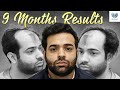 Jawdropping 9month hair transplant transformation  medlinks hair transplant delhi