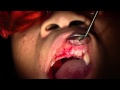 CAMLOG Implant Placement #7 &amp; 10, Full Video