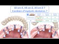 ALL ON 4 - Combien d'implants dentaires par mâchoire ?