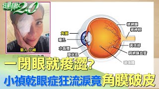 一閉眼就痠澀小禎乾眼症狂流淚竟角膜破皮 健康2.0