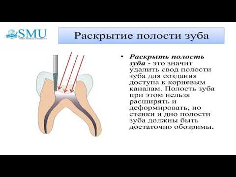 Методы лечения пульпитов