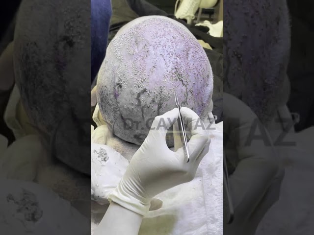 Hair Transplantation Process