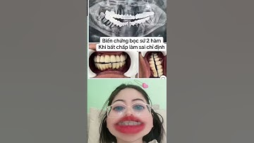 Hậu quả bọc sứ sai chỉ định | bọc răng sứ thẩm mỹ