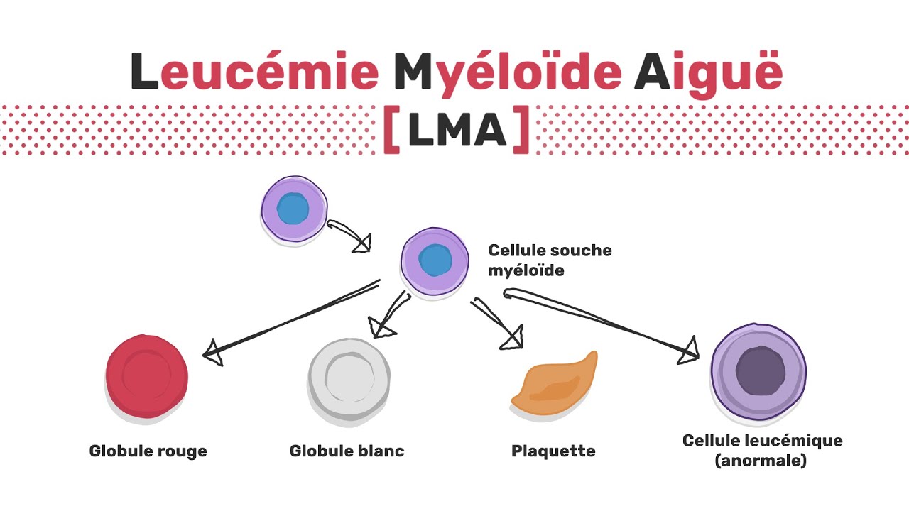Types de leucémie myéloïde aiguë