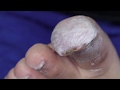 Ep_804 Infected ingrown toenail removal part 1 👣 น้องแคท..นักพากย์ 1 😁 (This clip from Thailand)