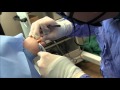 Hammer Toe Procedure