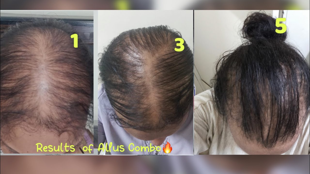 Hair Growth Transformation🔥With Proof
