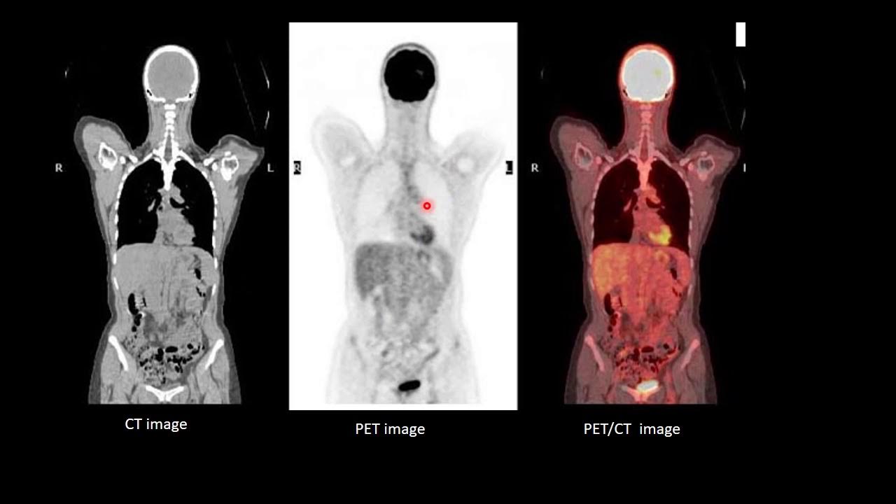 Пэт кт снимки метастазы. Пэт-кт опухоль позвоночника. Пэт кт почки. Пэт/кт с 18f-фдг с контрастом. Позитронно-эмиссионная томограмма.