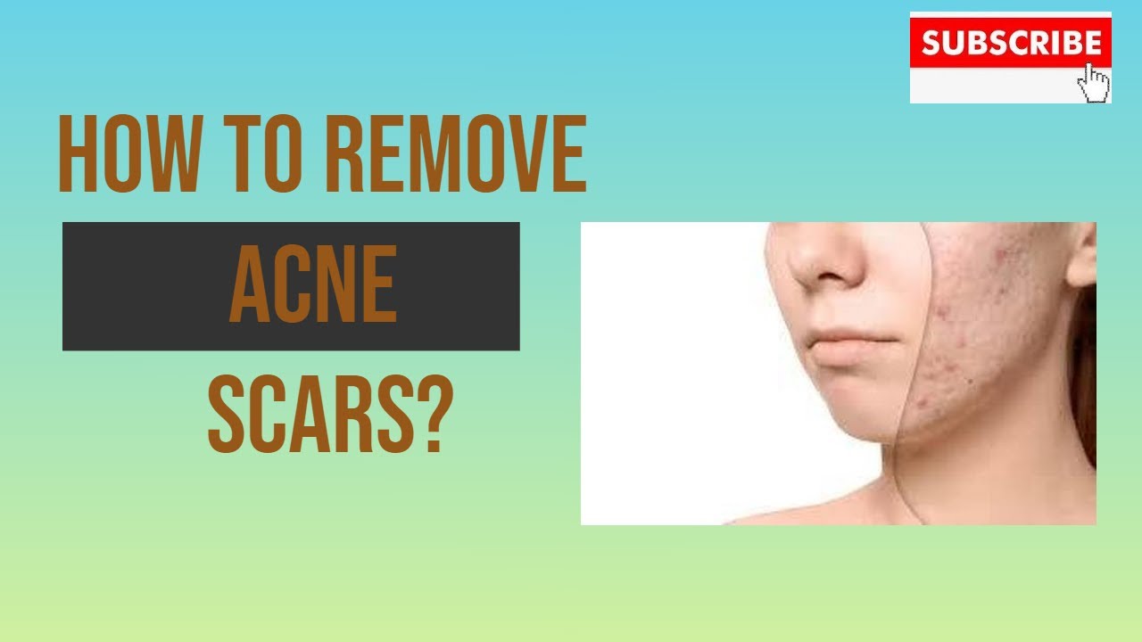 How to Get Rid of Acne Scars Naturally Remove Acne