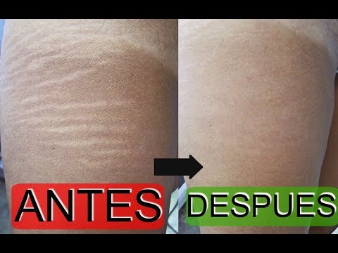 tengo 15 años y tengo estrias en la espalda