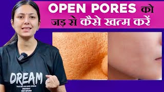 Open Pores का 100% इलाज सिर्फ 15 दिनों में | Home Remedies for Skin | Upasana ki Duniya
