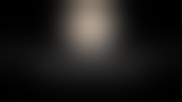 Difficult Lap Ureterocalicostomy for Post PCNL long segment PUJ & upper ureteric stricture Unedited