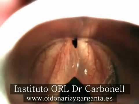 Edema cuerdas vocales operacion