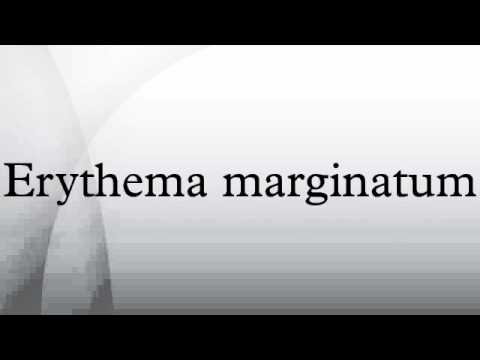 Erythema marginatum