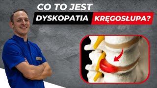 Dyskopatia kręgosłupa - Objawy i skuteczne leczenie