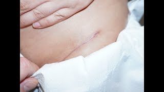 Hip Dysplasia 6 Week Follow Up After Direct Anterior Hip Replacement Doing Great | Dr. Robert Cagle