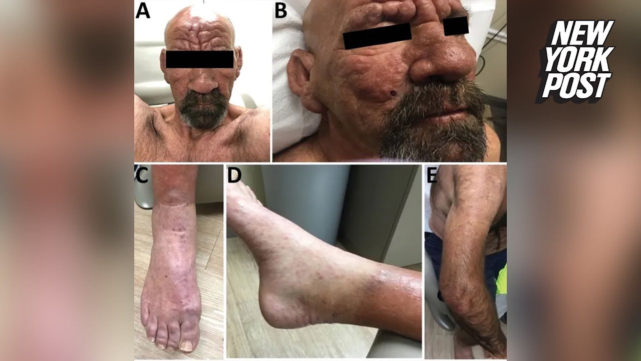 Leprosy could become endemic to Florida. Here is what to know.