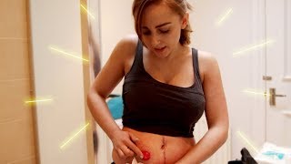 What the heck is a stoma? (showing you my ileostomy) | Hannah Witton