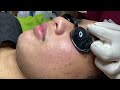 Acne treatment for spa linh mun 2024 90