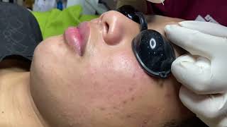 Acne treatment for Spa Linh Mun 2024 #90