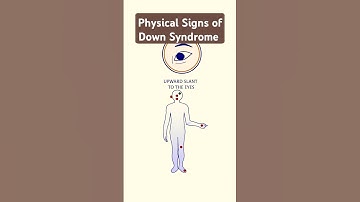 Physical features of Down Syndrome #downsyndrome #trisomy21 #biotechreview #learningbiology